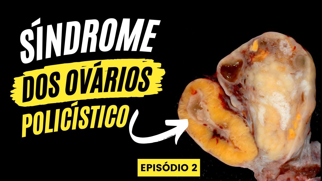 O melhor tratamento para ovário policístico