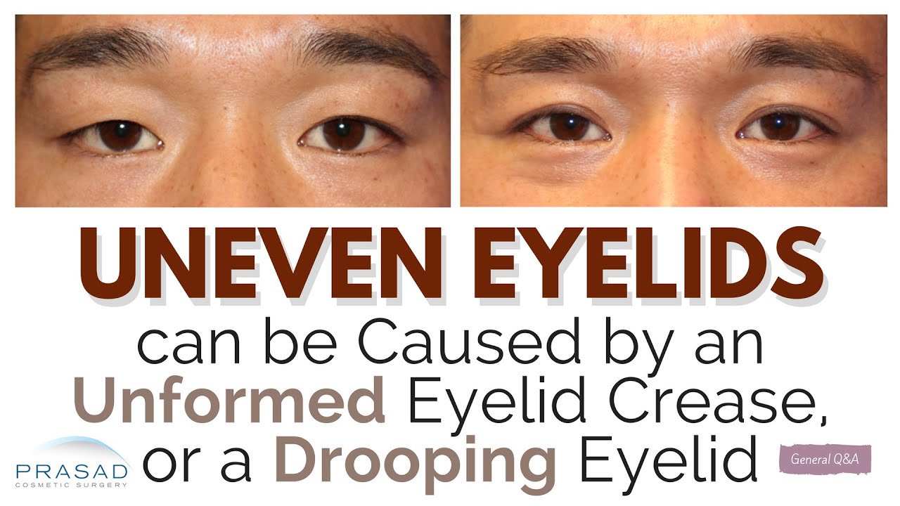 How Uneven Eyelids May be Due to an Unformed Eyelid Crease, or Ptosis (Drooping Eyelid)