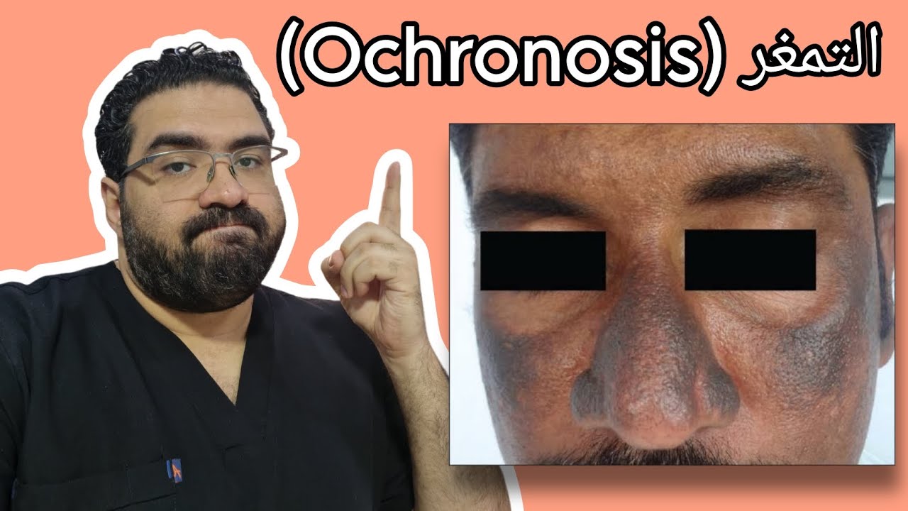 عيادة الجلدية - حلقة ٧ - التمغُر (Ochronosis)