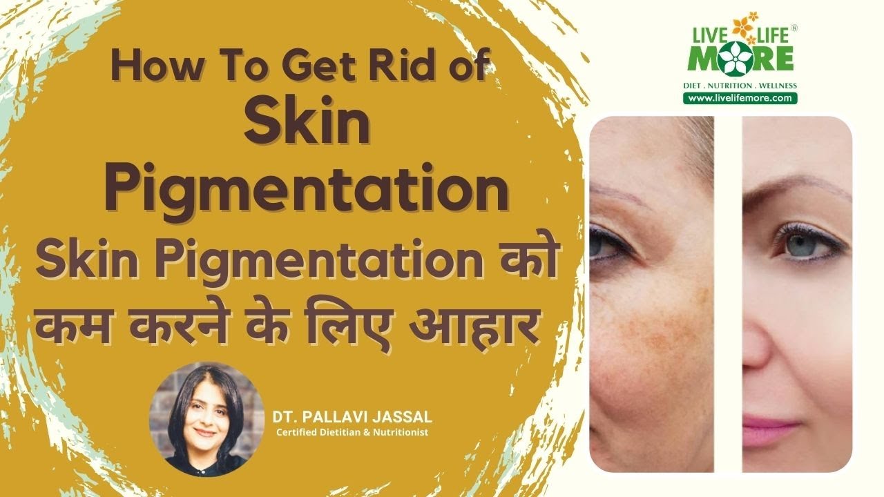Diet Plan For Hyperpigmentation - Reduce Skin Pigmentation - Nutrition Deficiency - Home Remedies