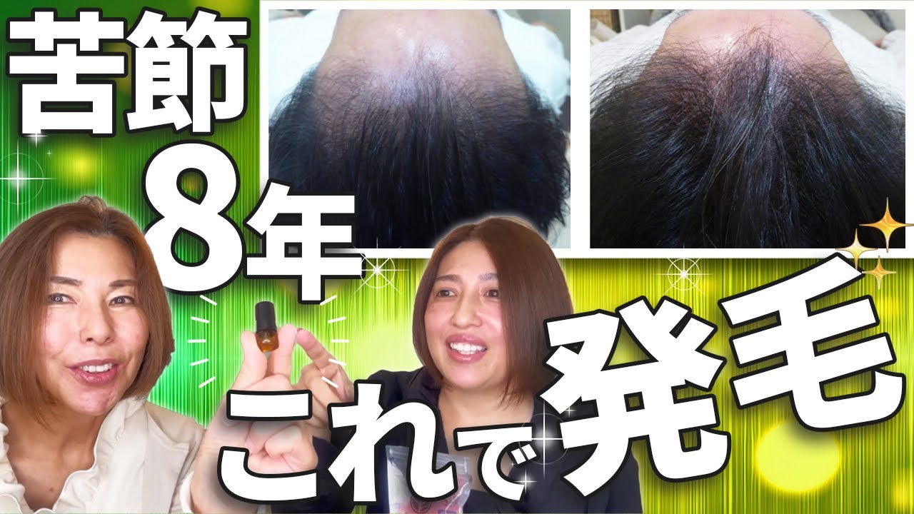 育毛剤は使わない特別な発毛の仕方伝授 銀賞歴８年が今プラセンタで爆再発毛