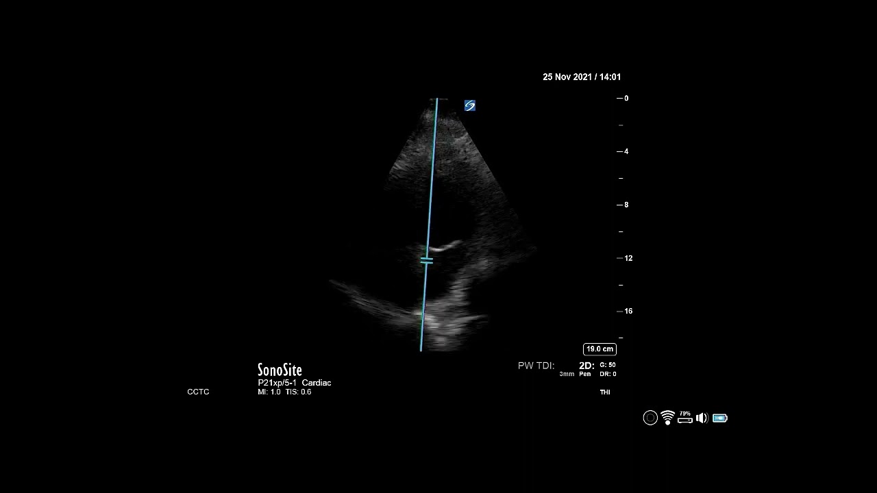How to... Measure Left Atrial Pressure