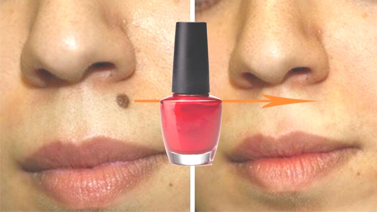 Verrugas e Marcas desaparecerão como nunca -100% Eficaz | Remover pintas na Pele