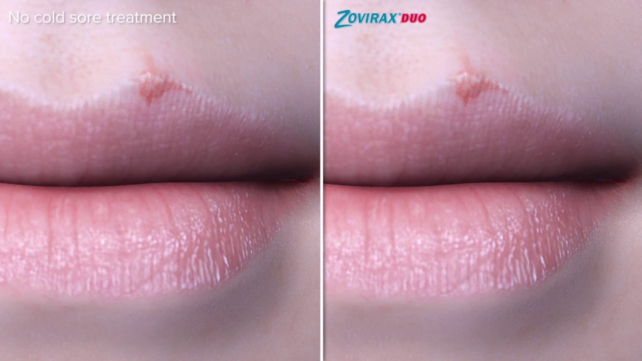 Zovirax Duo - Animation