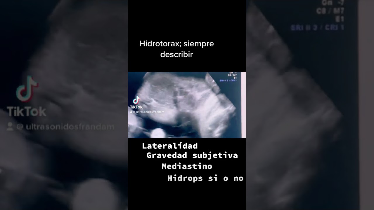 Hidrotorax fetal