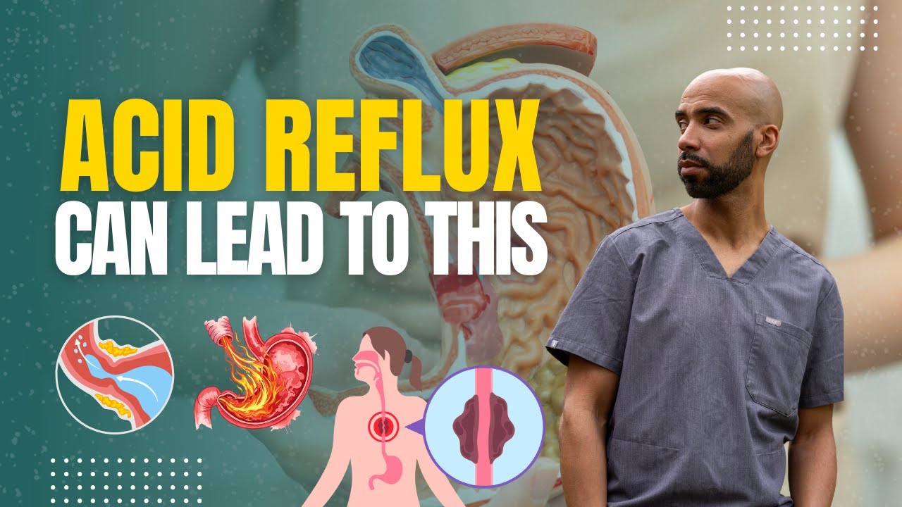 Barrett’s Esophagus: The Hidden Risk That Can Lead to Esophageal Cancer