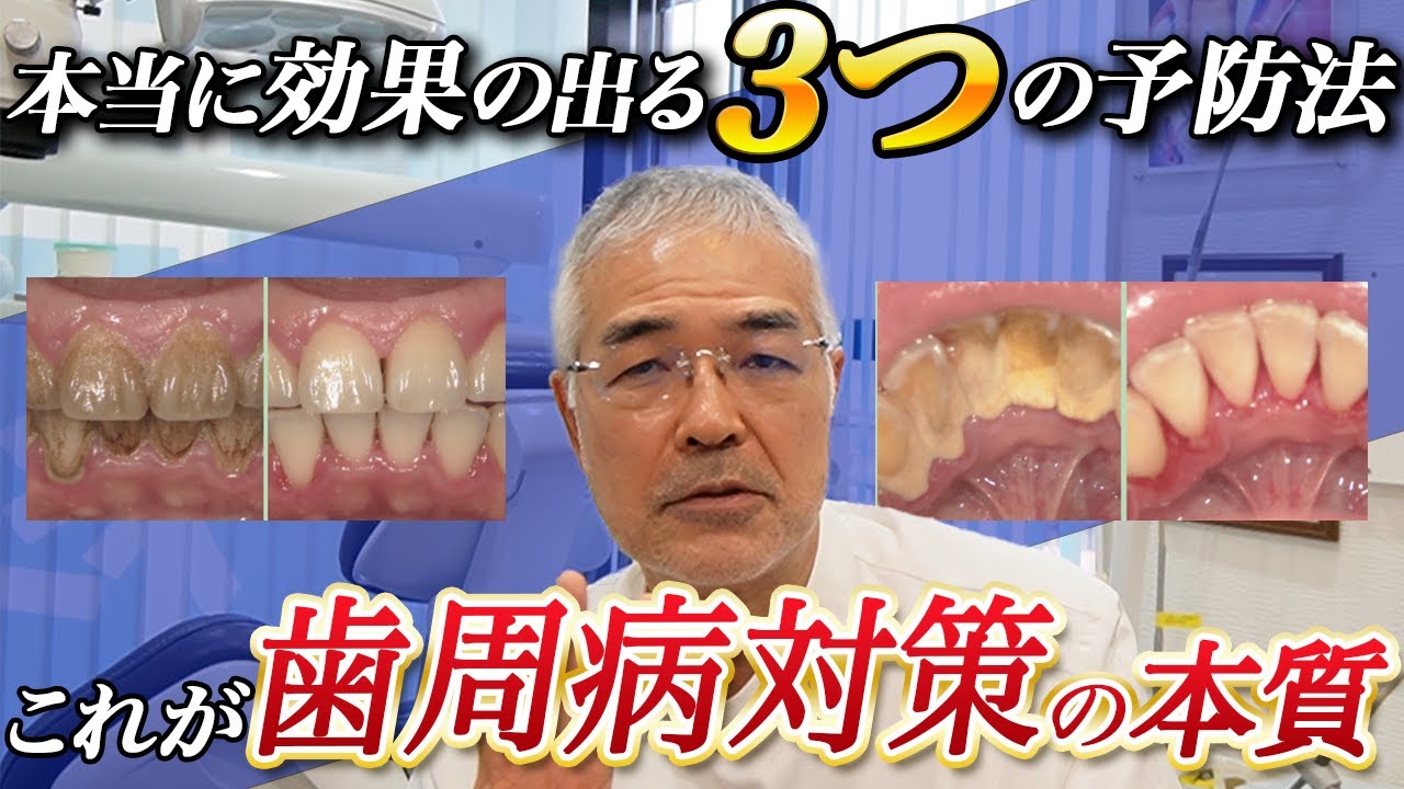 【本当に伝えたい】本当に効果の出る3つの歯周病予防法（医学論文・書籍＆歯科医が語る）