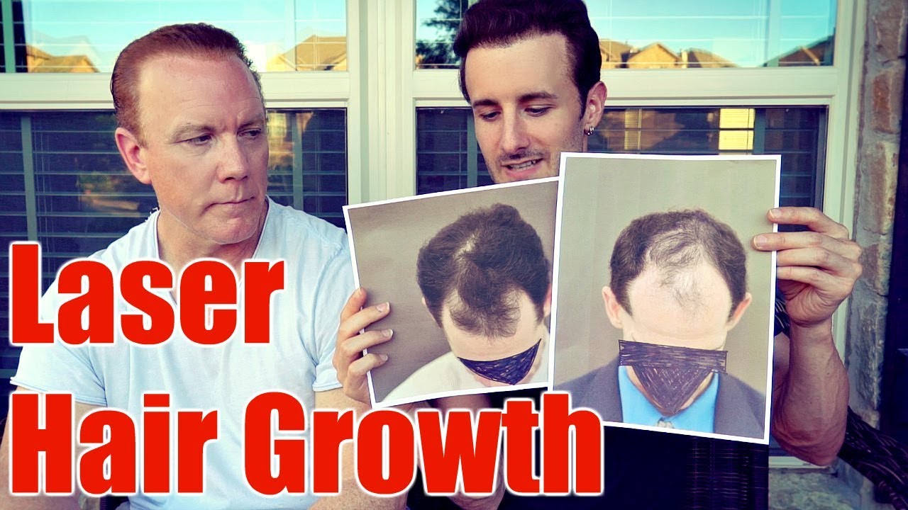 Does Laser Hair Growth For Hair Loss Really Work?