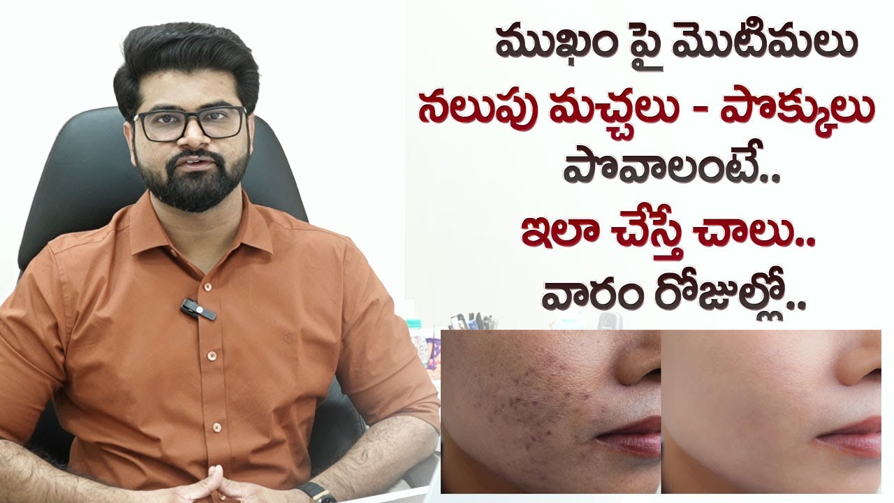 Top 5 Tips To Remove Dark Spots Fast | Remove Pimple Marks & Acne Scars Naturally | Beauty Tips