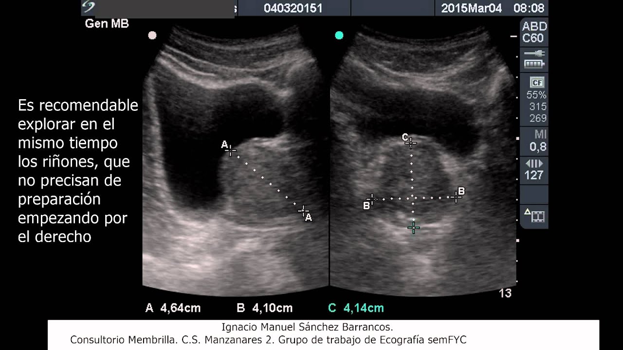 Vesicoprostatica y renal con texto