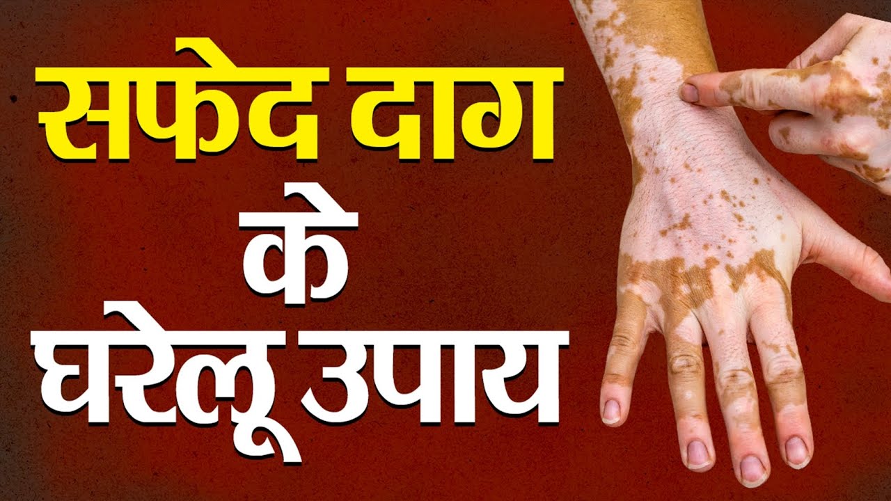 सफेद दाग के घरेलू उपाय | home remedies for white spots