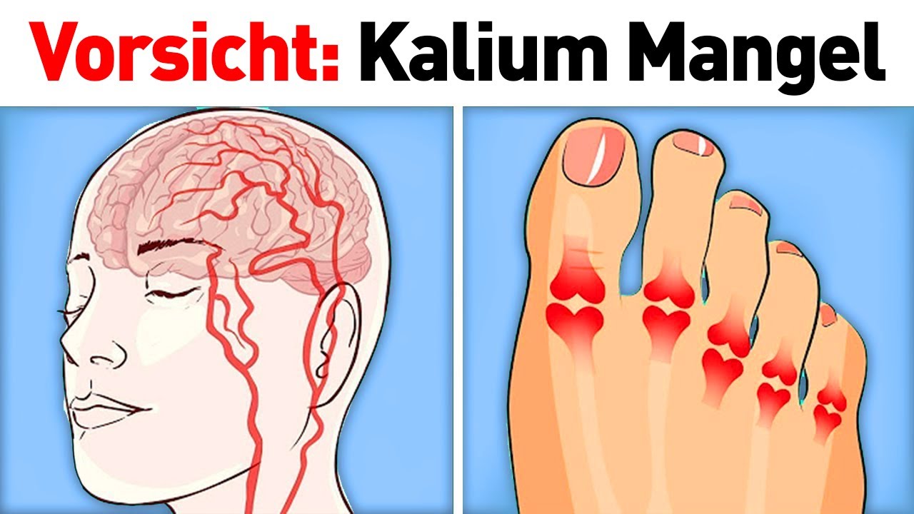 3 Anzeichen von akutem Kalium-Mangel....
