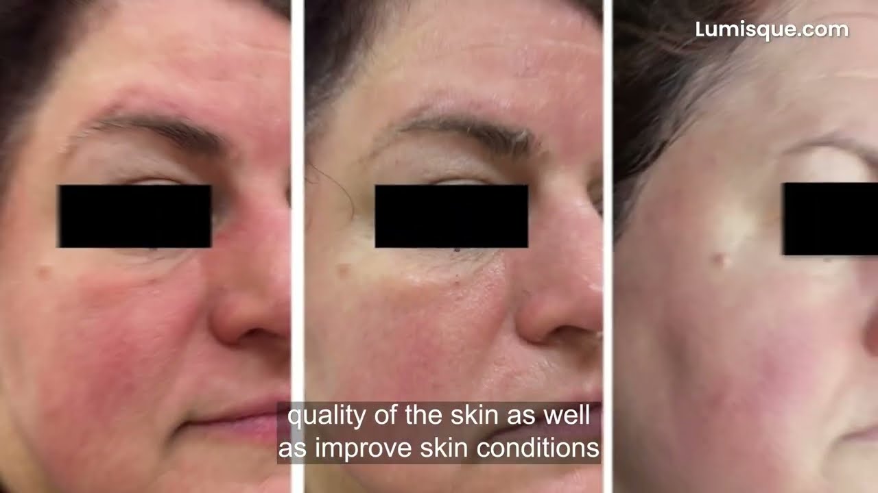 CO2LIFT PRO Carboxy Therapy Mask