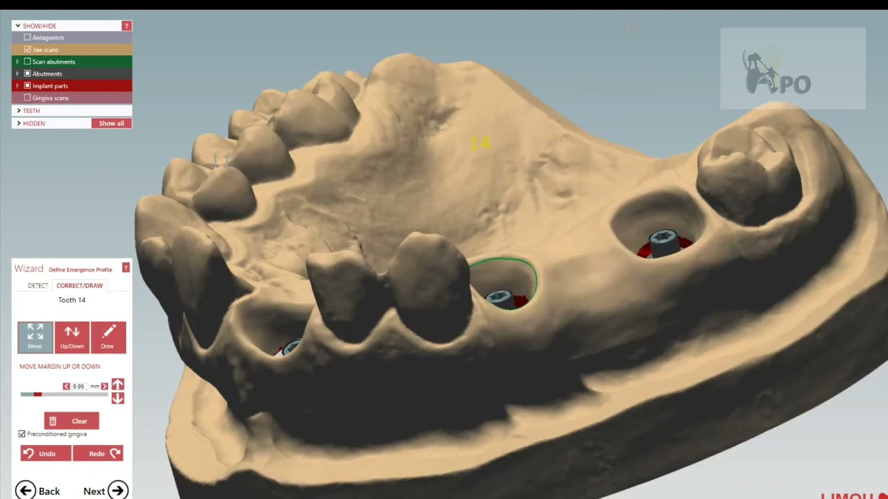 exocad(10) screw retained custom abutment and bridgeأ.حسان نور الدين