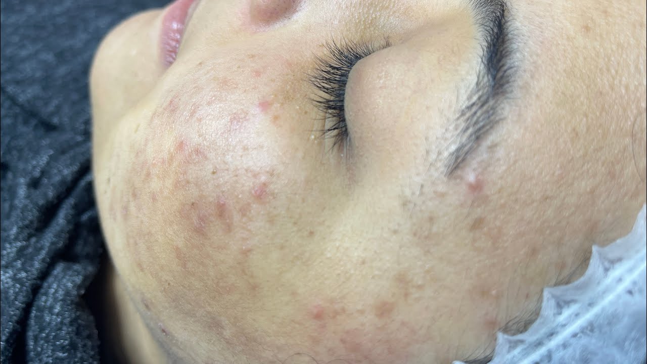 جلسه ديرما بن اول جرعه لعلاج اثار حبوب#dermapen #ديرما #جلسات #بشرة_الكوريات #beautiful #dj