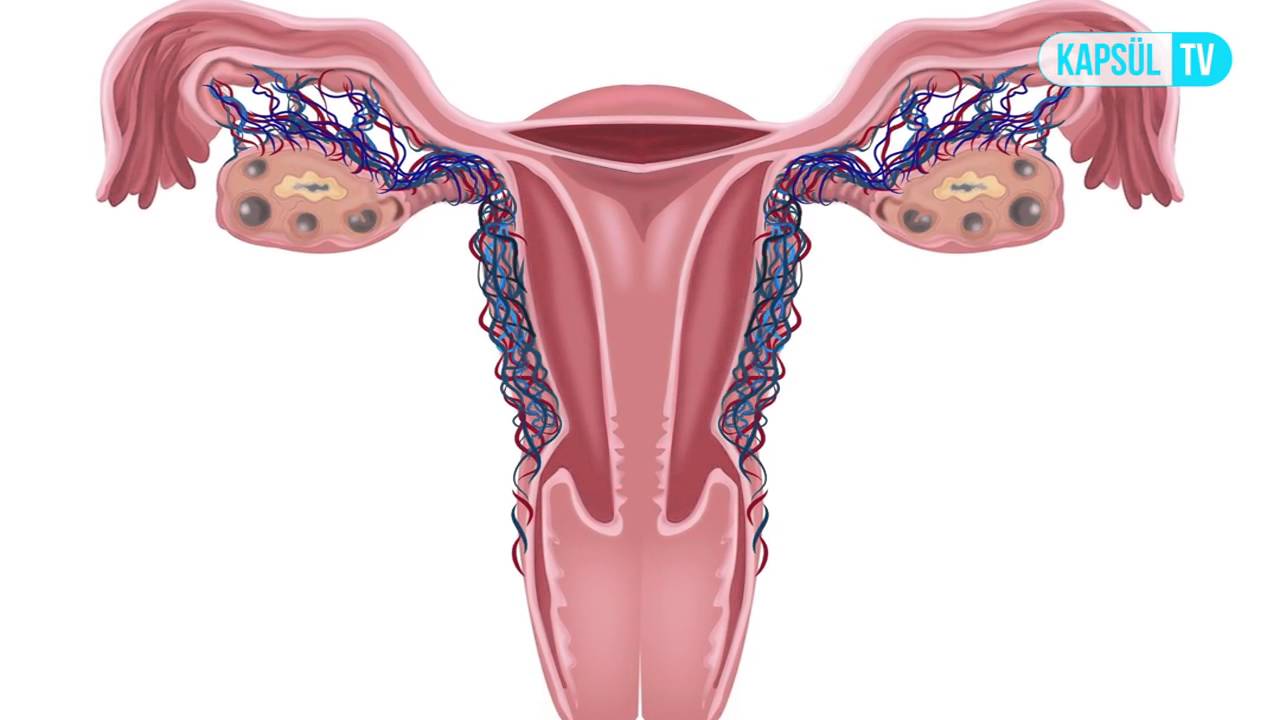 Endometriozis Neden Olur?