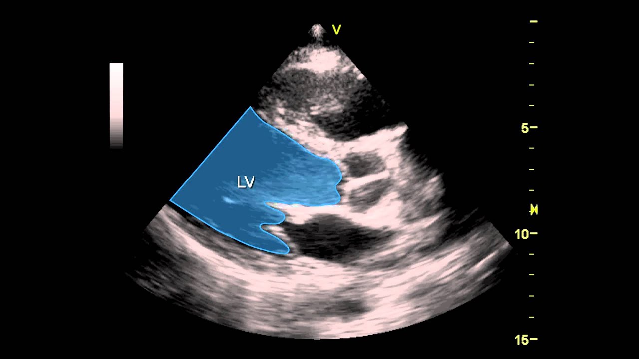 Parasternal Long Axis View