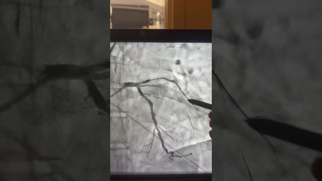 Too Risky for bypass Surgery?  Life-Saving Complex multi vessel PCIs! Advanced PCI Techniques! 