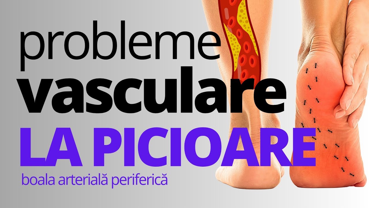 Cum știi că ai Probleme Vasculare la PICIOARE: Boala Arterială Periferică