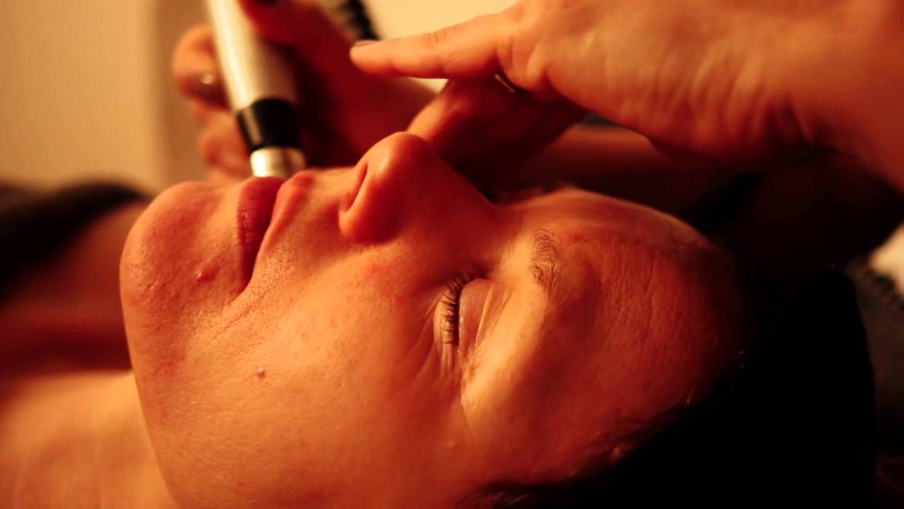 How does Microdermabrasion work?