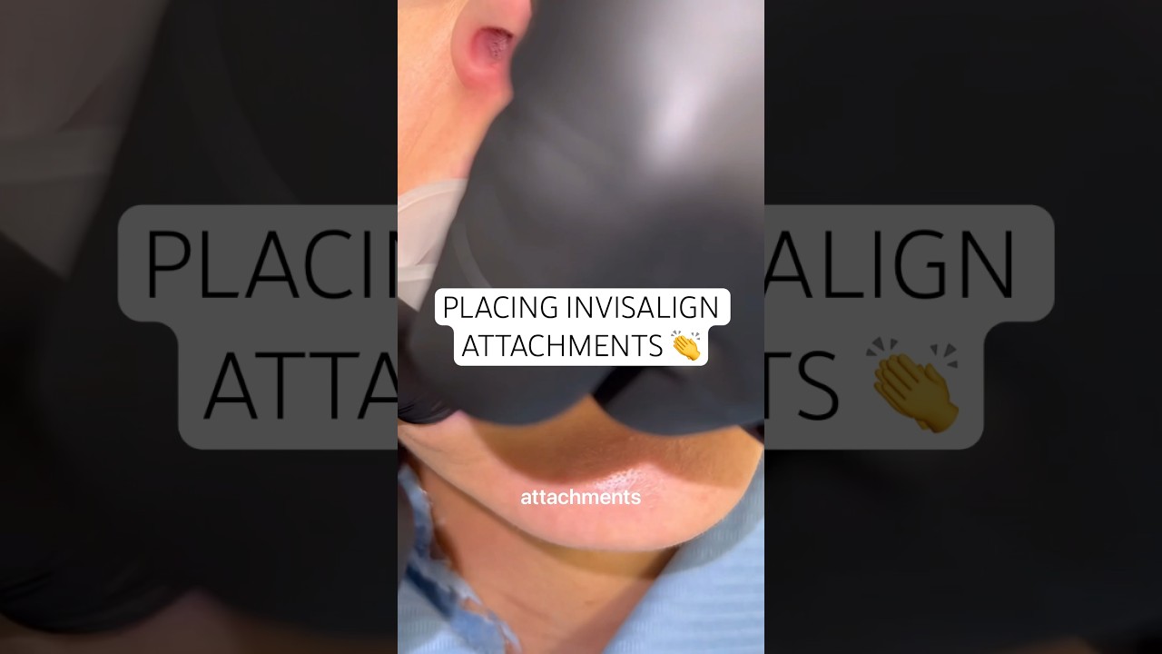 Watch as Dr. Ravi places Invisalign attachments 👏 #ruhdental #invisalign