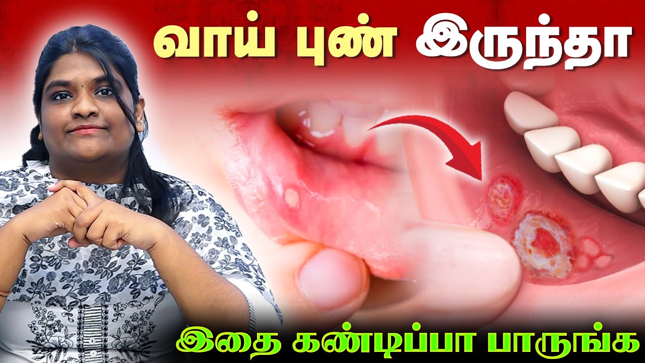 ⚠️ வாய் புண் – காரணமும் தீர்வும் | Dentist Explains | Universe Dental Care | Trichy