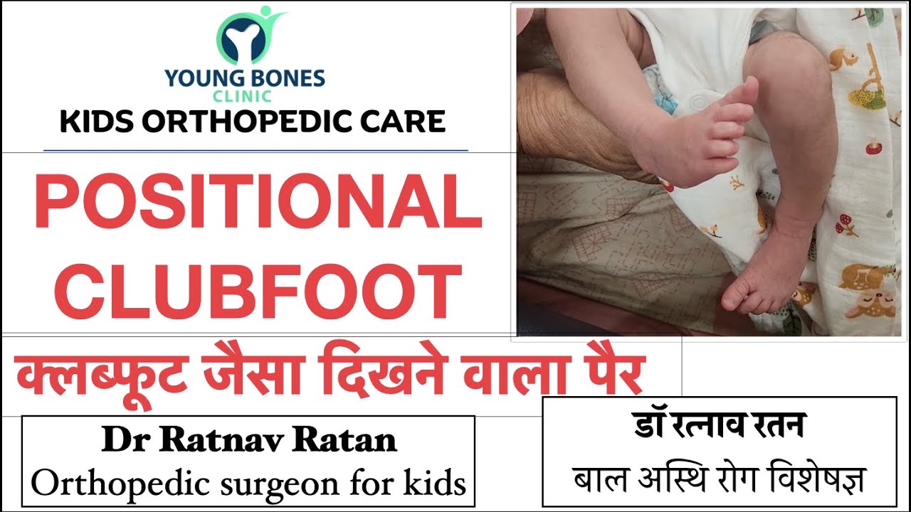 POSITIONAL CLUBFOOT : All you need to know|Clubfoot type foot| Dr Ratnav Ratan|CTEV treatment