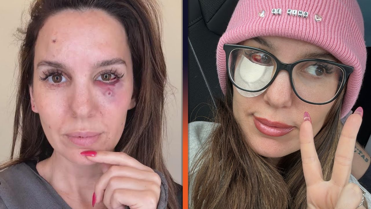 Christy Carlson Romano Reveals She Was Shot in the Face
