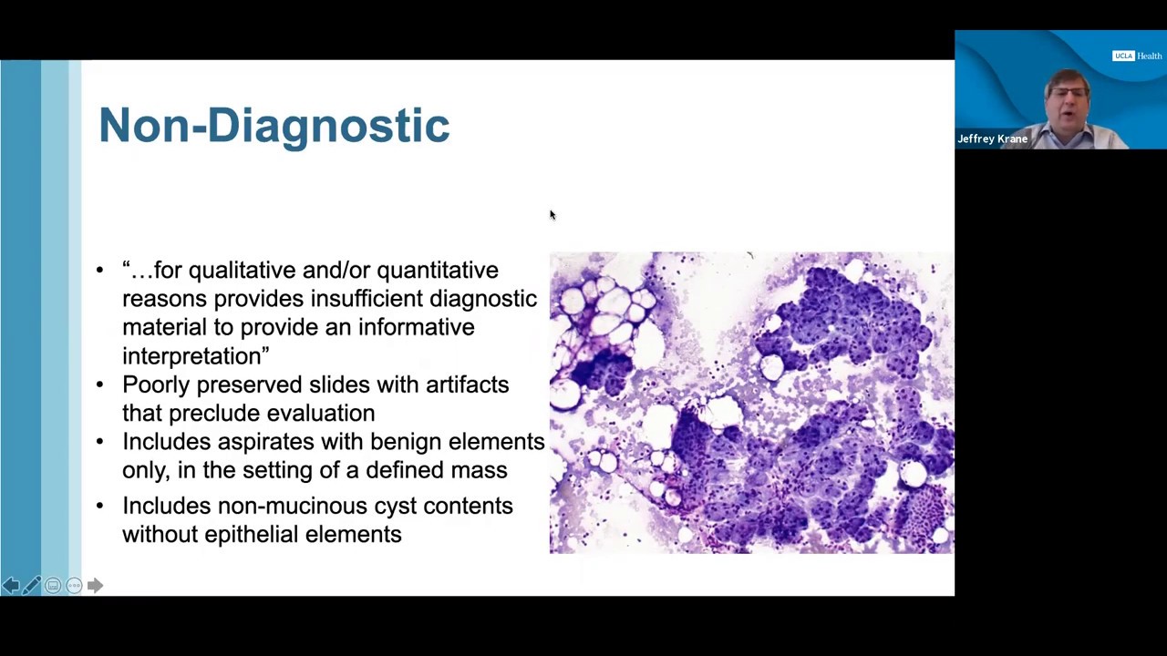 UW Path Grand Rounds - Dr. Jeffrey Krane - Ancillary Testing for Diagnosis of Salivary Gland Tumors
