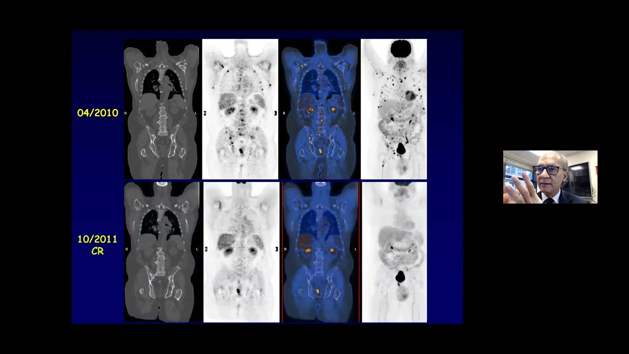 Multiple Myeloma 101: Diagnosis, Prognosis, and Risk: Nikhil C. Munshi, MD