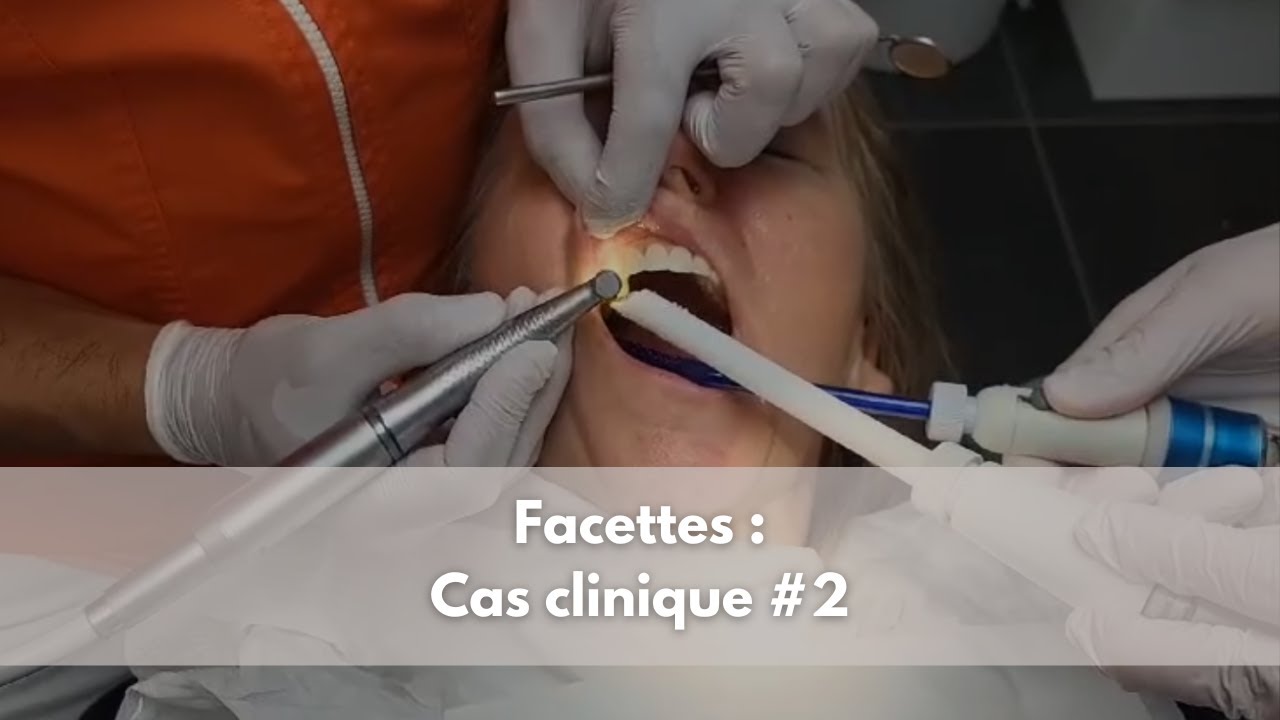 Facettes - Cas clinique #2