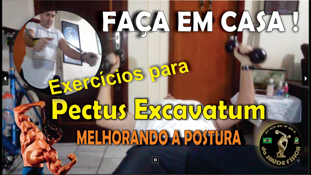 Exercícios para PECTUS EXCAVATUM ! Saiba os melhores exercícios para corrigir esta má formação !!