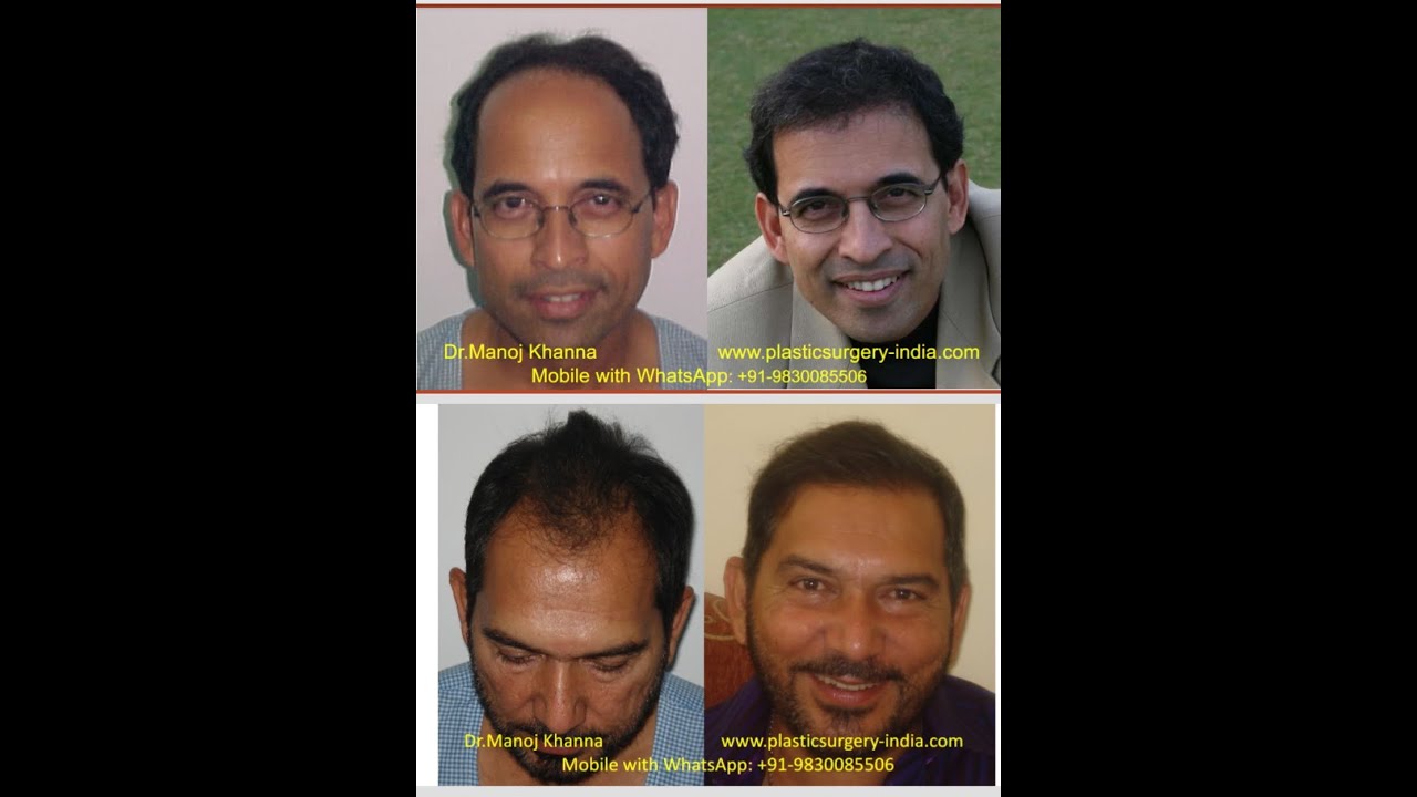 #BestHairtransplantinKolkata by Dr.Manoj Khanna. Procedure,cost,before & after.Live TV