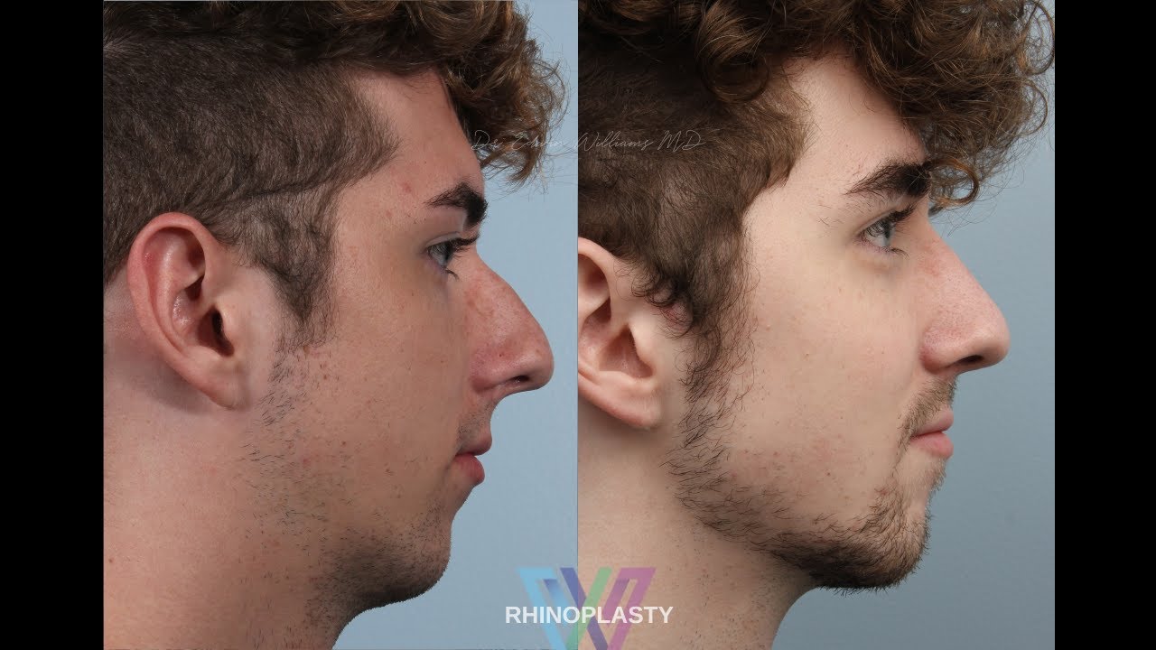 Male Rhinoplasty Testimonial: 