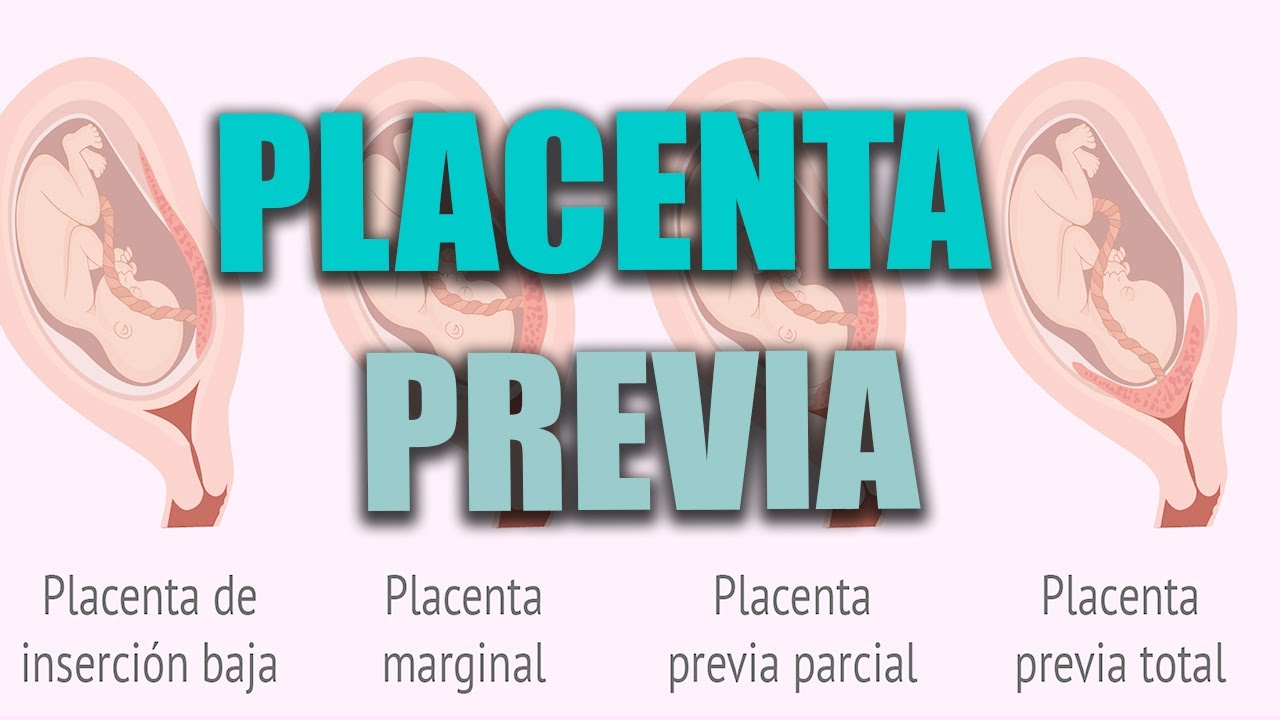 PLACENTA PREVIA en el embarazo, placenta baja ¿Qué es? ¿Cómo afecta al parto la placenta previa?