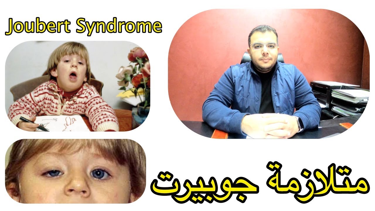 متلازمة جوبيرت | Joubert syndrome