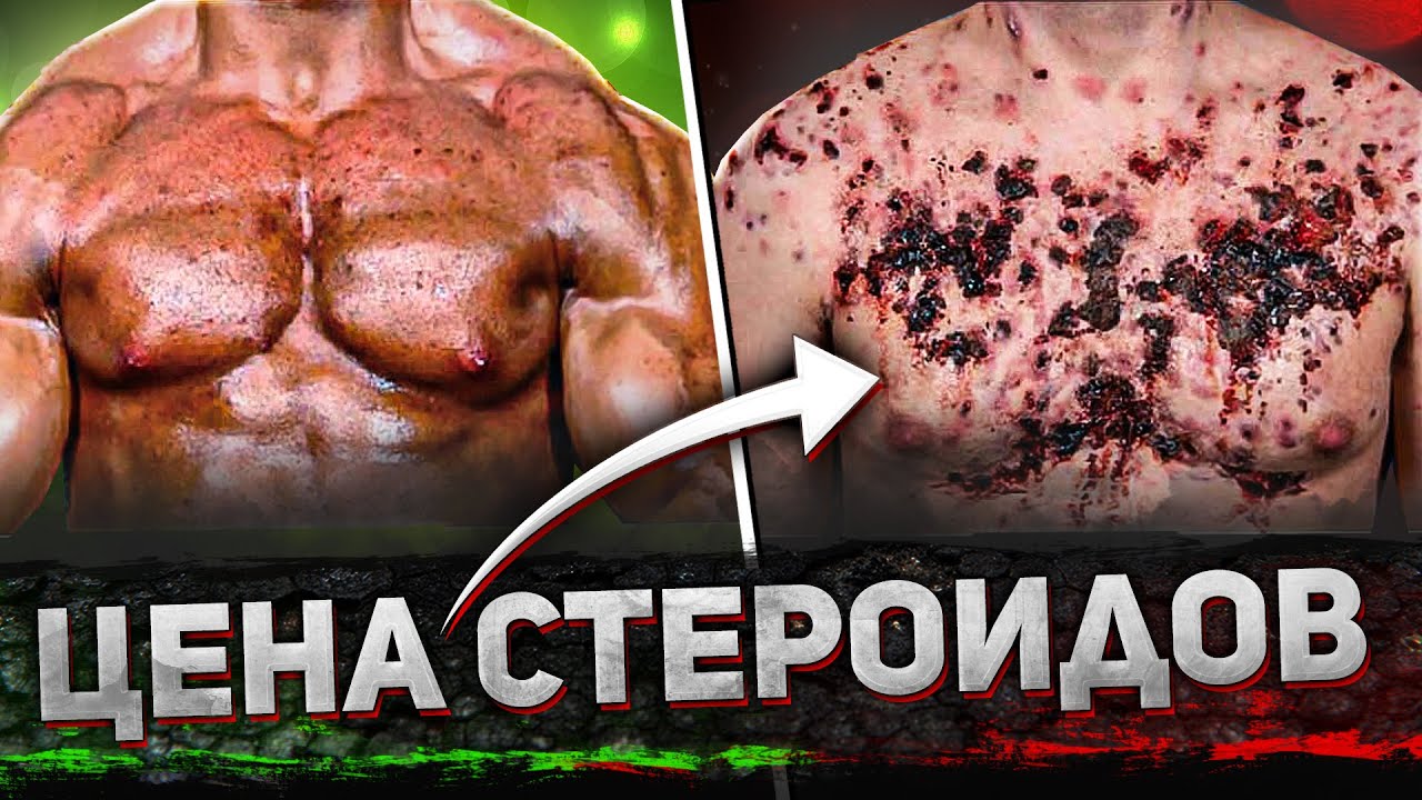ГНИЮЩАЯ КОЖА СЛАЗИЛА ОТ ХИМИИ / откровения бывшего химика
