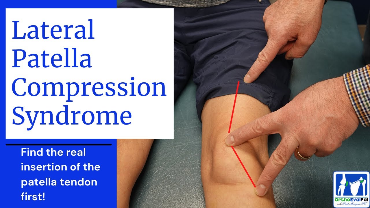 Lateral Patella Compression Syndrome (LPCS)