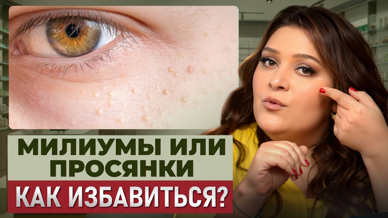 Как БЫСТРО убрать МИЛИУМЫ на лице в домашних условиях? Как ИЗБАВИТЬСЯ от белых точек