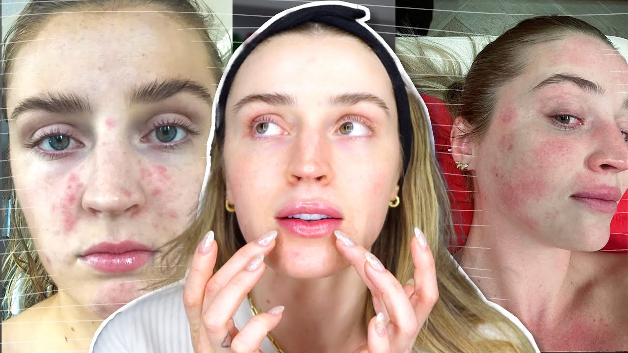 WHAT I'VE HAD DONE TO MY FACE & Would I do it Again.. 👀