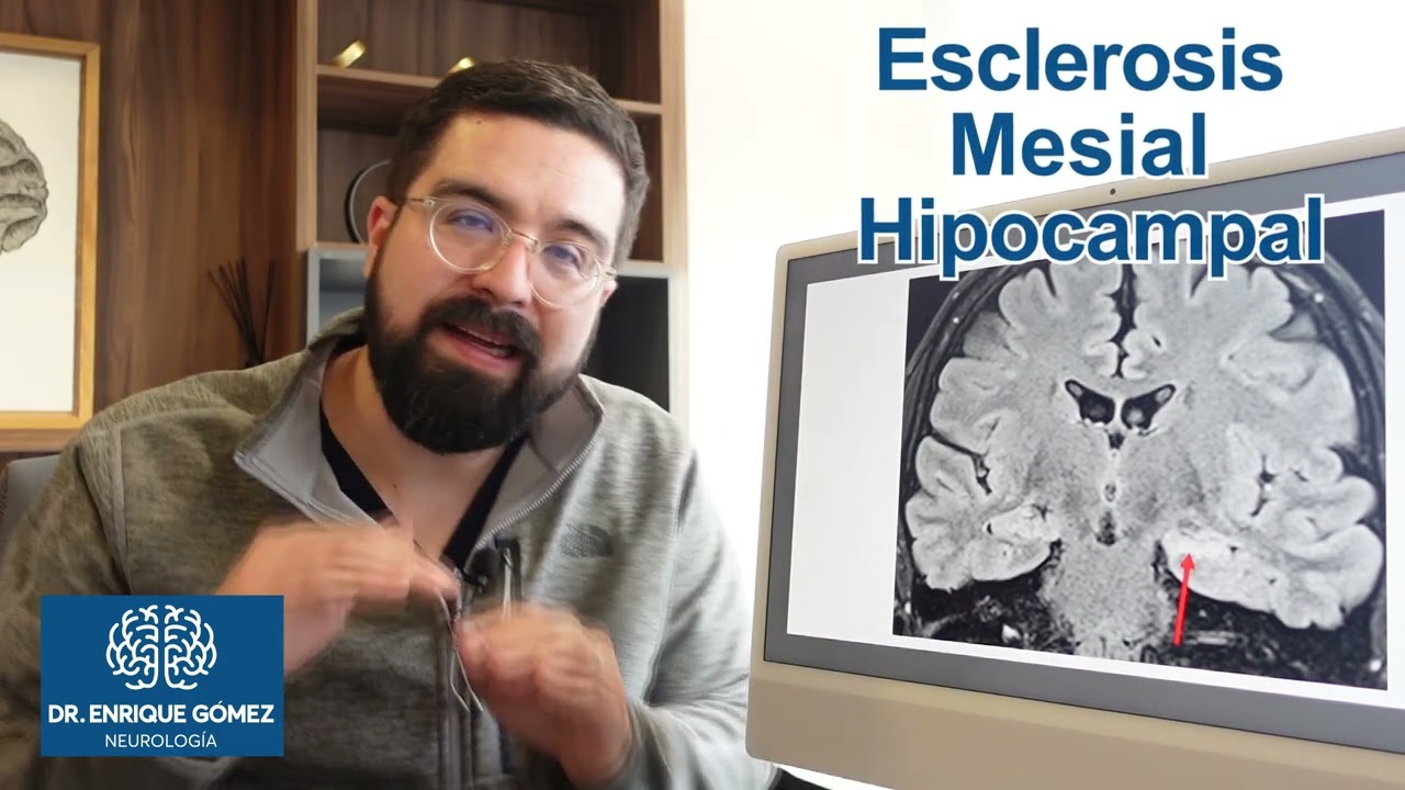 Esclerosis Mesial Hipocampal ¿Qué es el Hipocampo?