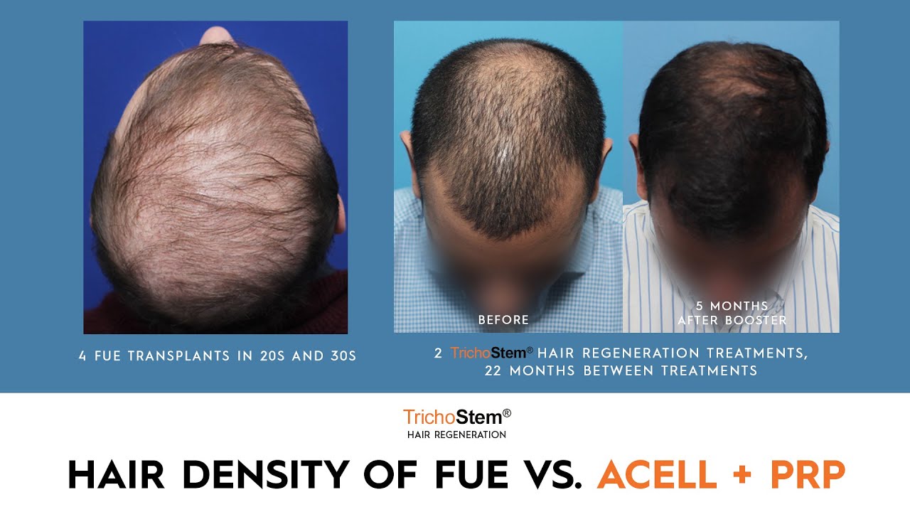 Factors in Choosing FUE Hair Transplant, or ACell PRP Treatment