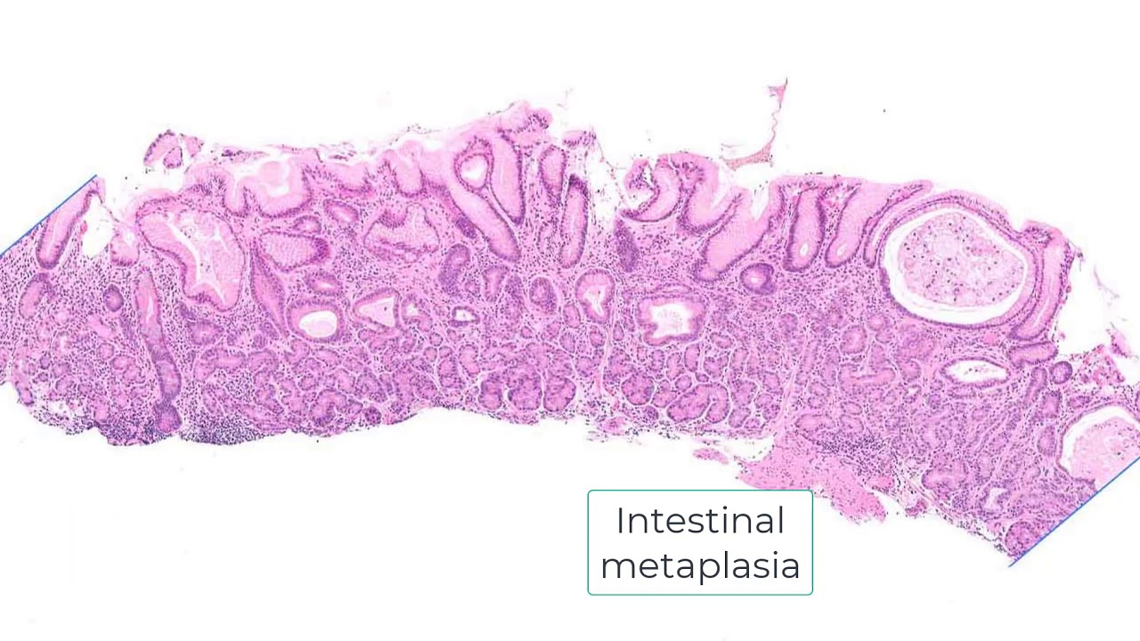 Autoimmune gastritis and differential diagnosis