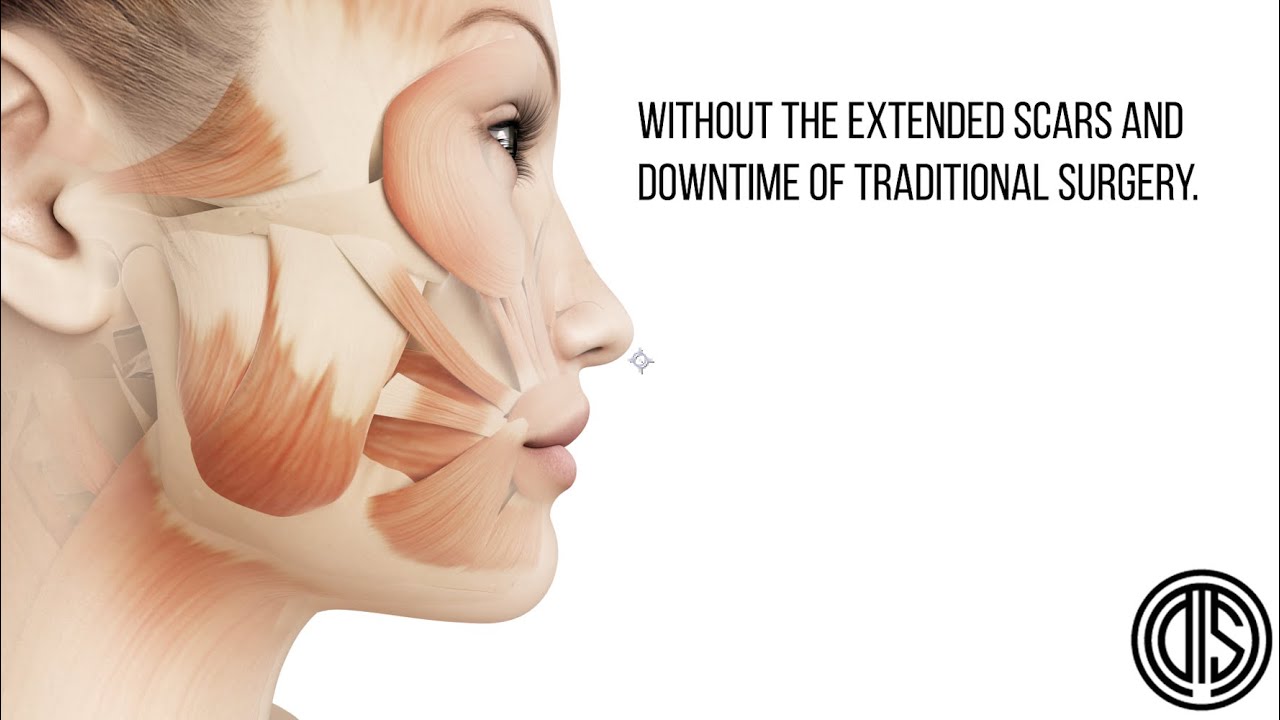 MyEllevate by Dr. Darren Smith: NYC's Minimally Invasive Neck Lift