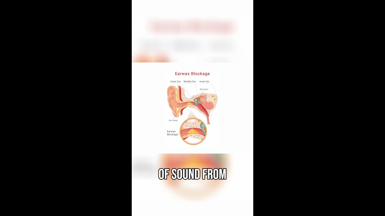 Hearing Loss from Earwax?