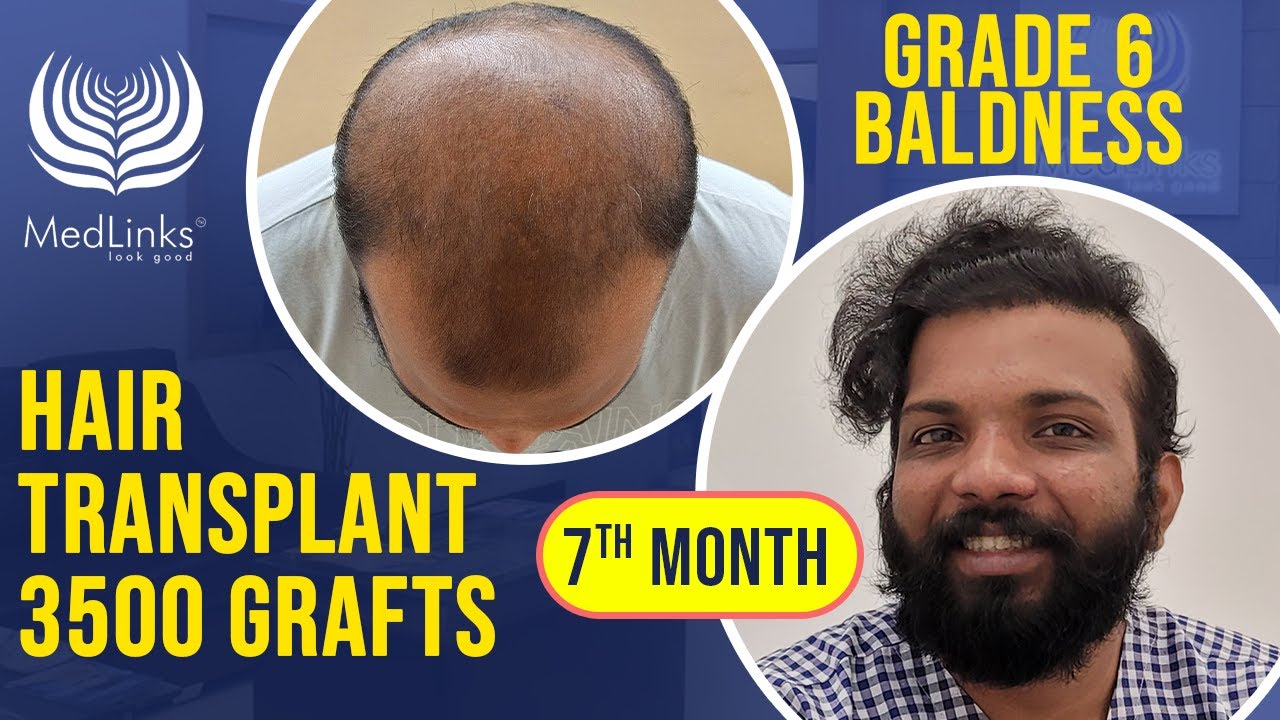 💥Stunning Hair Transplant Result in India | Before and After Results | Grade 6 Baldness Treatment