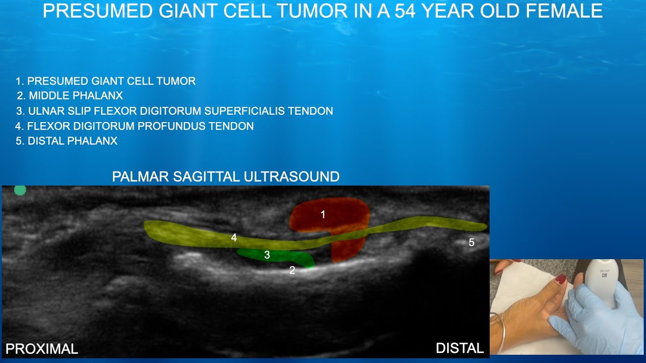 Ultrasound of a Presumed Giant Cell Tumor in the Index Finger Flexor Tendon Sheath.