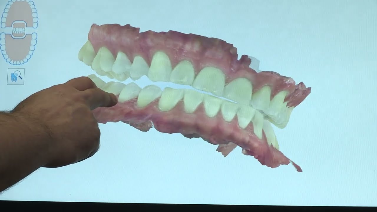 Digital Dentures in Fostoria, OH | 3D Scans for Better Fit