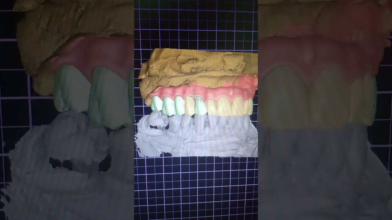 protocolo digital CAD Cam  exocad 🦷