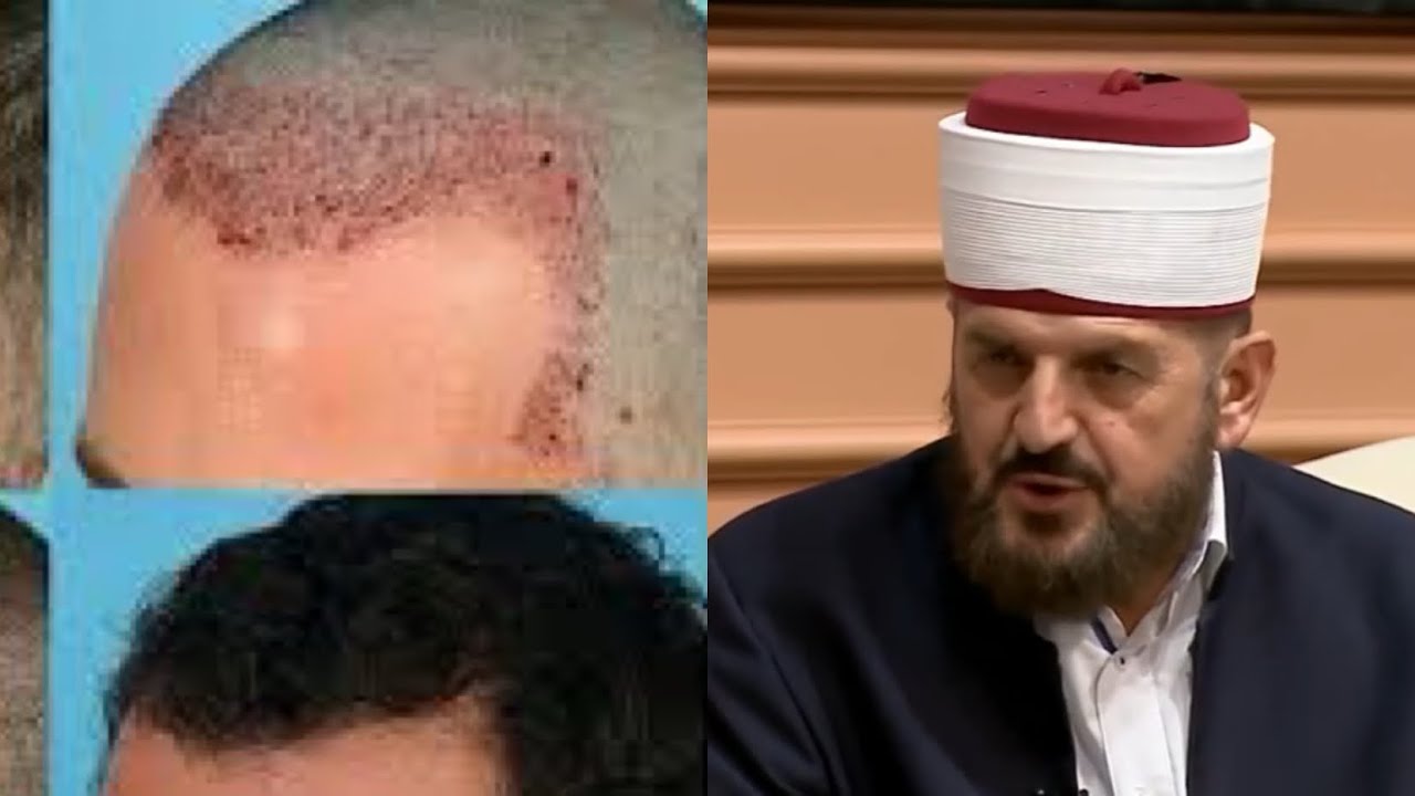 Deklarat bomb e Dr.Shefqet Krasniqi : ja pse lejohet mbjellja e flokut sipas Kuranit !